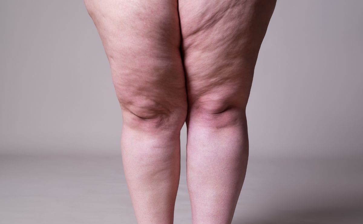 https://www.tododisca.com/en/wp-content/uploads/2021/11/4-tips-for-slimming-leg-fat-in-a-healthy-way.jpg