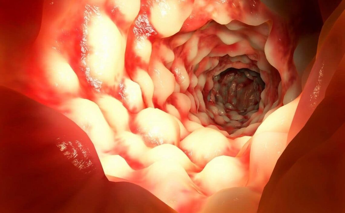 Enfermedad Crohn sistema digestivo tracto intestinal digestión salud dolor
