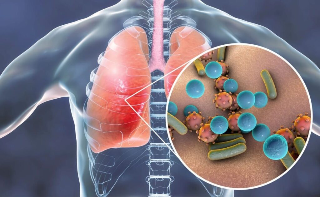 Dengue Influenza Coronavirus infeccion respiratoria