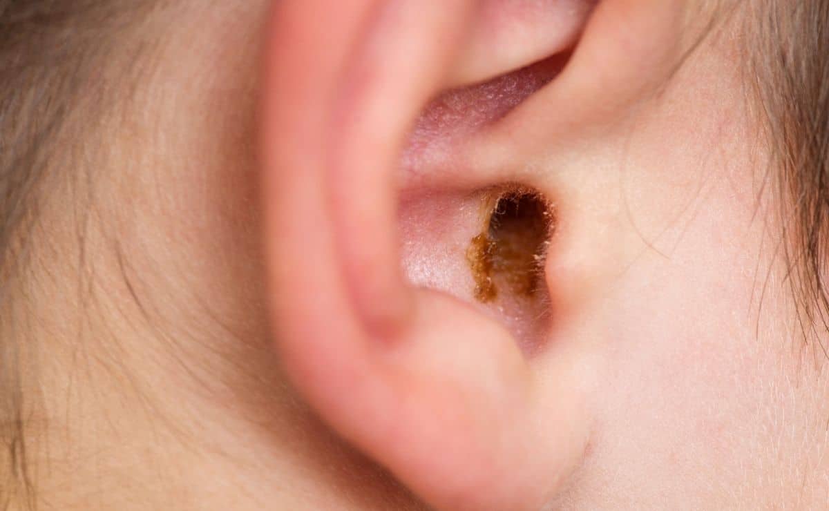 Salud: Los remedios caseros para quitar el exceso de cera del oído