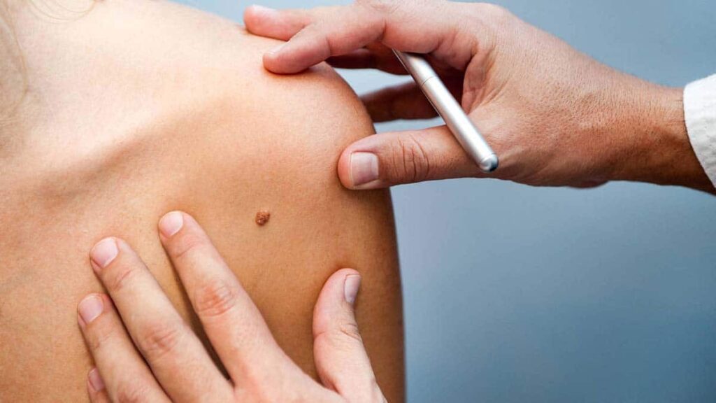 melanoma sistema inmunológico