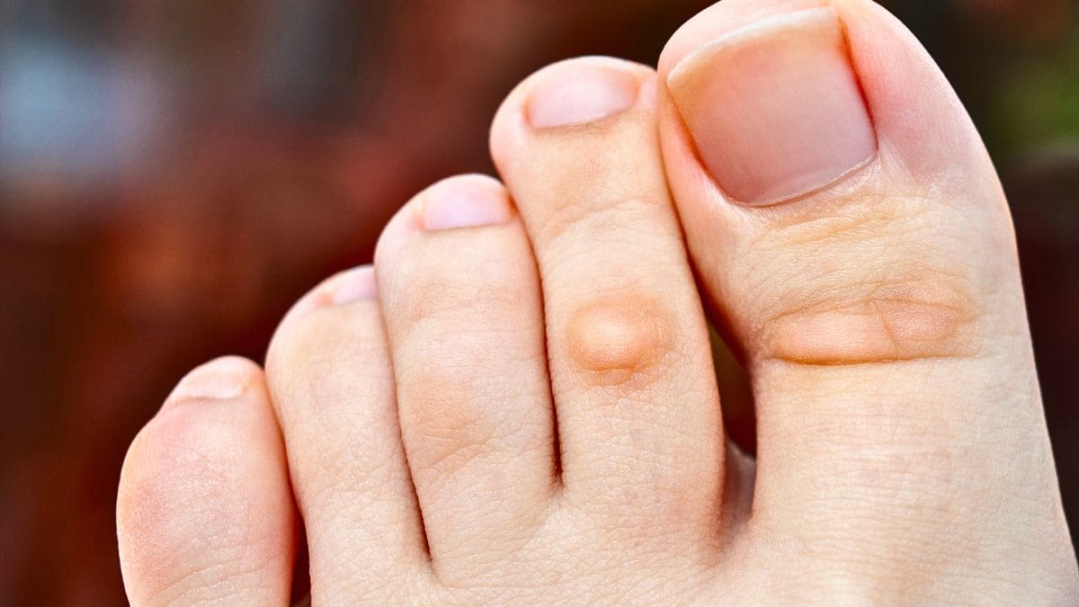 5 remedios para eliminar definitivamente los callos de los pies