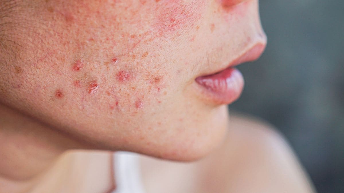 Cómo eliminar las manchas en la cara cara según los expertos